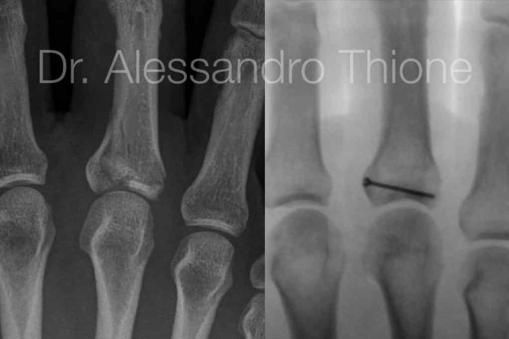 Fractura intrarticular de base de falange proximal tratada con tornillo a compresión.