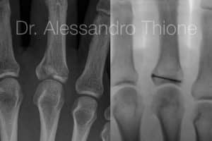 Fractura intrarticular de base de falange proximal tratada con tornillo a compresión.