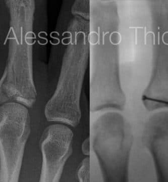 Fractura intrarticular de base de falange proximal tratada con tornillo a compresión.