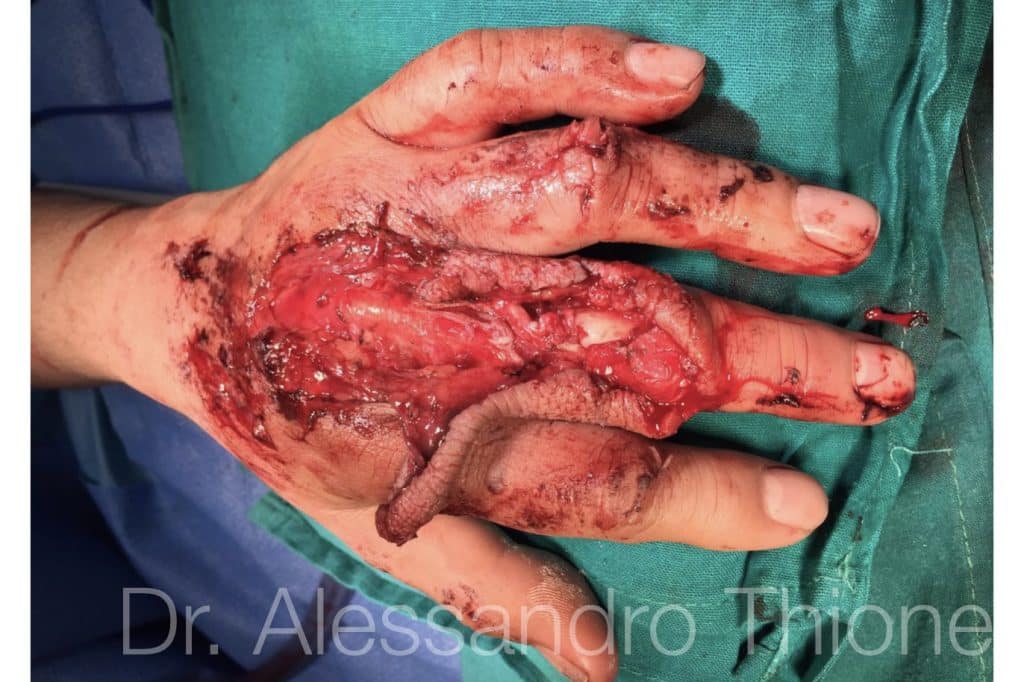 Herida dorso mano y fractura abierta dedo