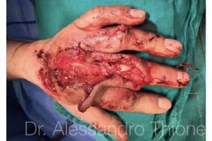 Herida dorso mano y fractura abierta dedo