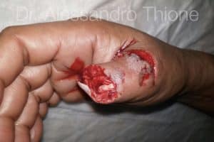 Amputación del pulgar y reimplante