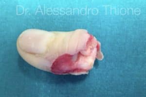 Amputación del pulgar de la mano