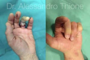 Arrancamiento y desvascularizacion de la piel de un dedo por anillo