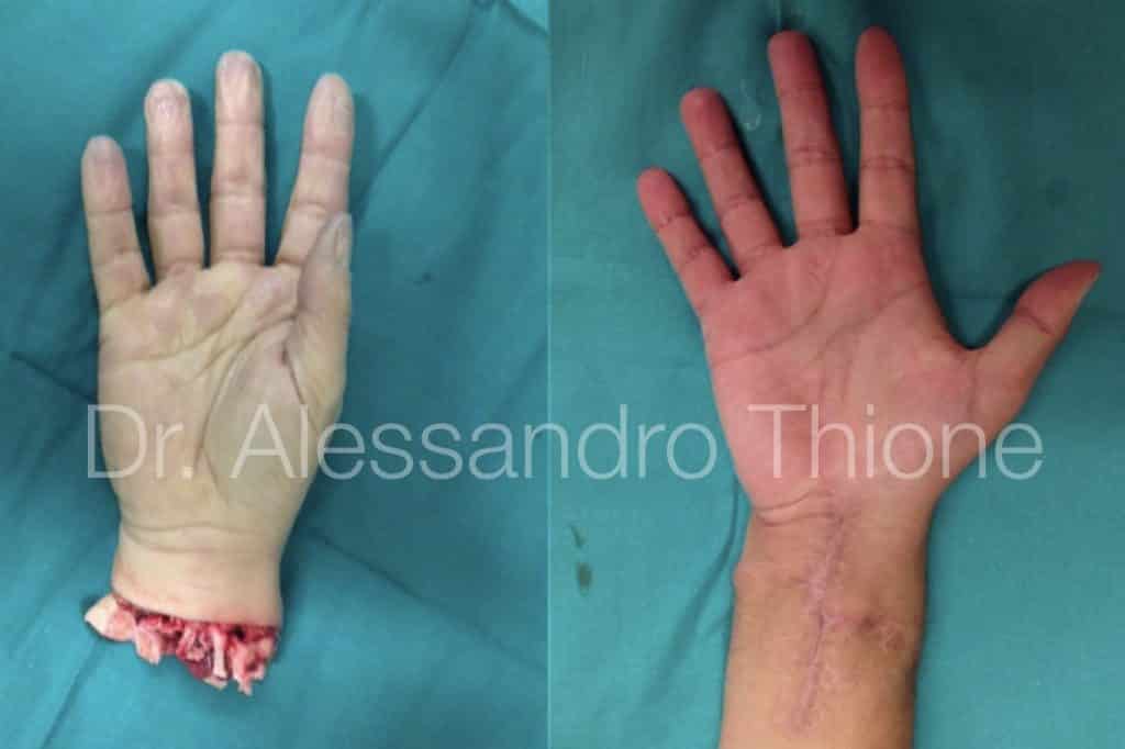 Amputacion de mano y reimplante.