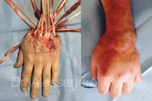 Amputacion de mano con arrancamiento de tendones