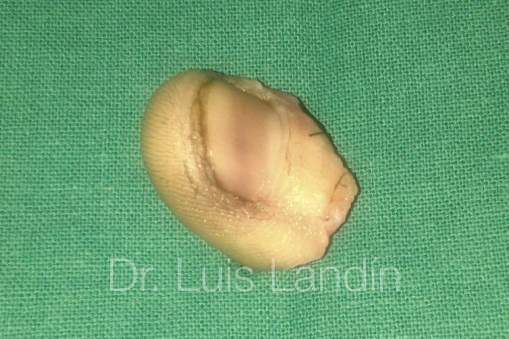 Dedo pulgar amputado