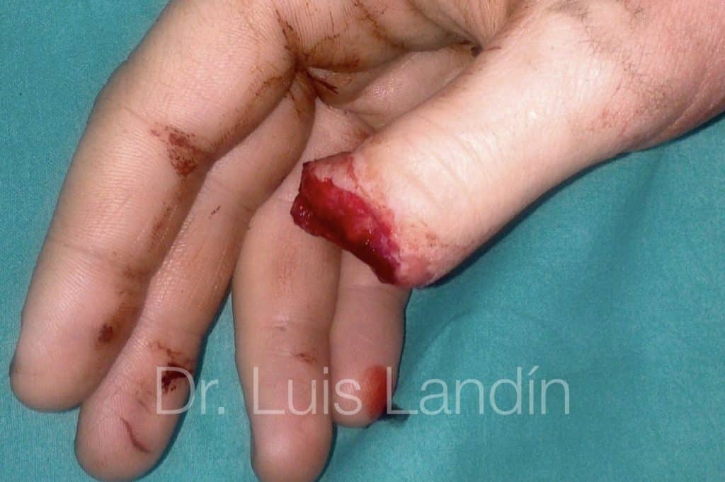 Amputación de dedo pulgar