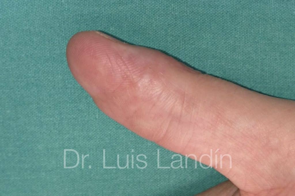 Foto de reimplante de pulgar