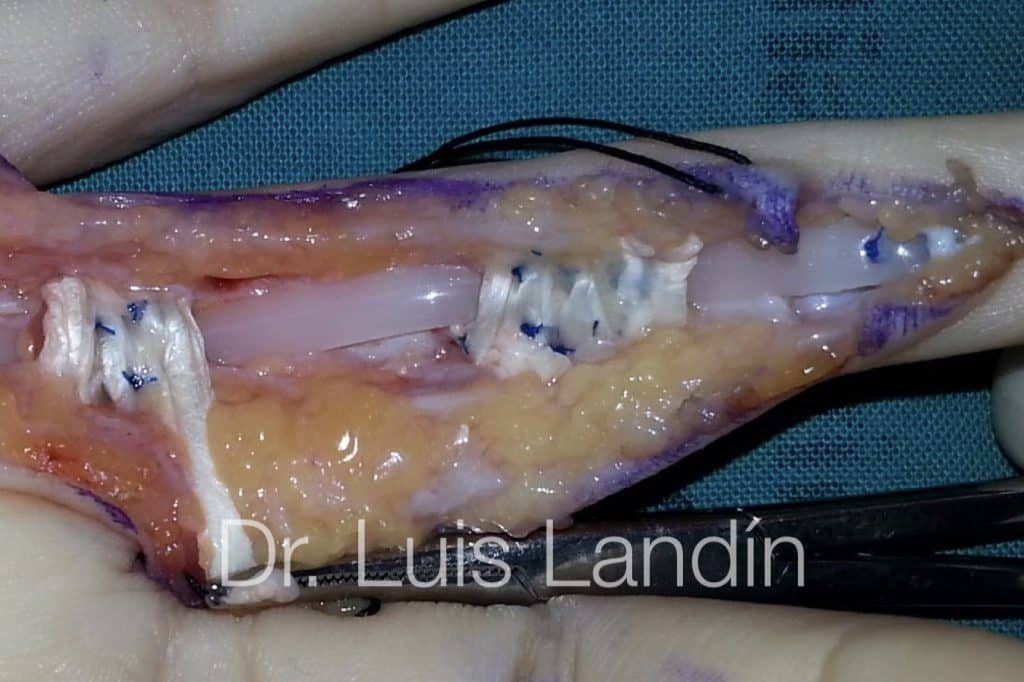 Reconstrucción de poleas de tendón flexor.