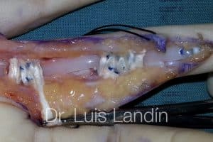 Reconstrucción de poleas de tendón flexor.