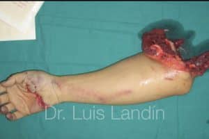 Amputación de brazo. Reimplante de brazo