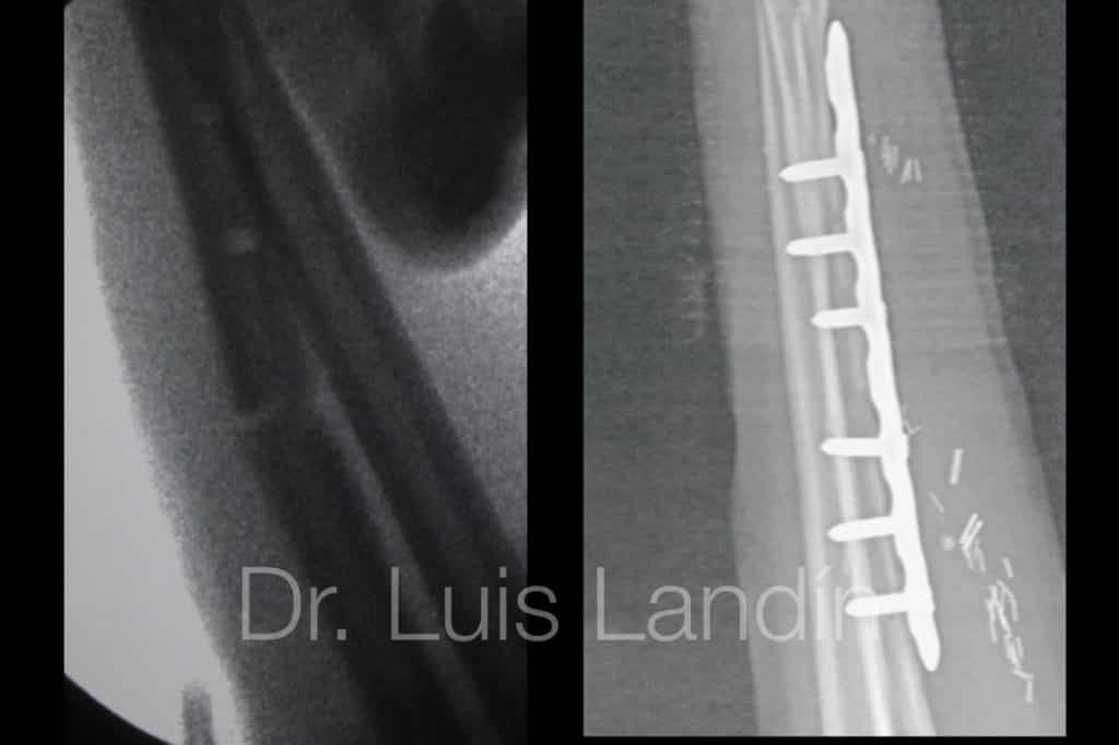 Fractura d eradio tratada con plca y tornillos