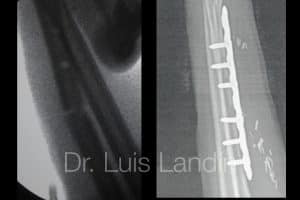 Fractura d eradio tratada con plca y tornillos