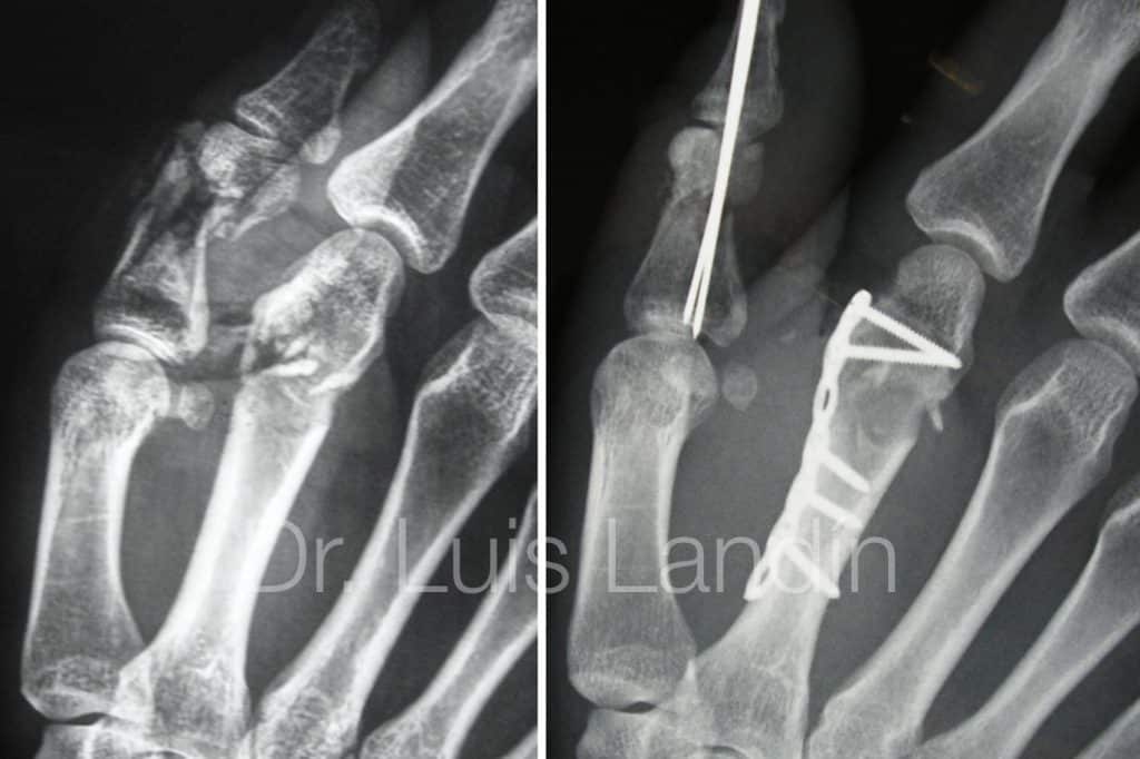 Fracturas múltiples en una mano