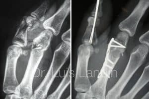 Fracturas múltiples en una mano