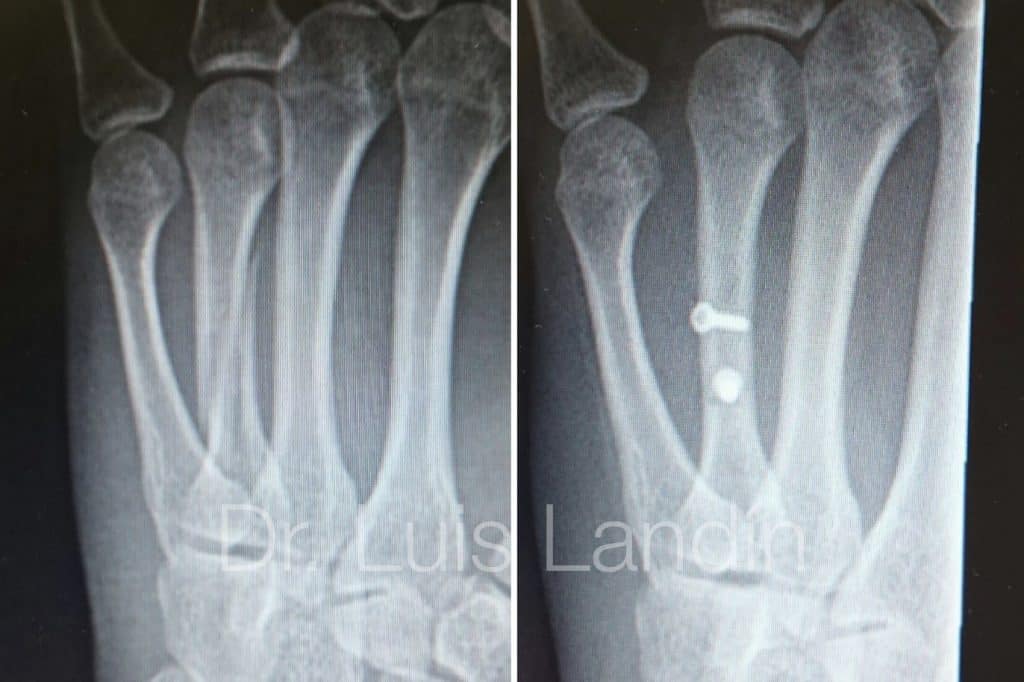 Fractura metacarpiano fijada con tornillos a compresión