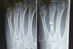 Fractura metacarpiano fijada con tornillos a compresión