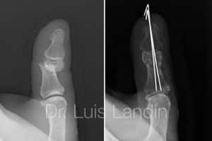 Fijación de falange de pulgar con agujas de Kirschner