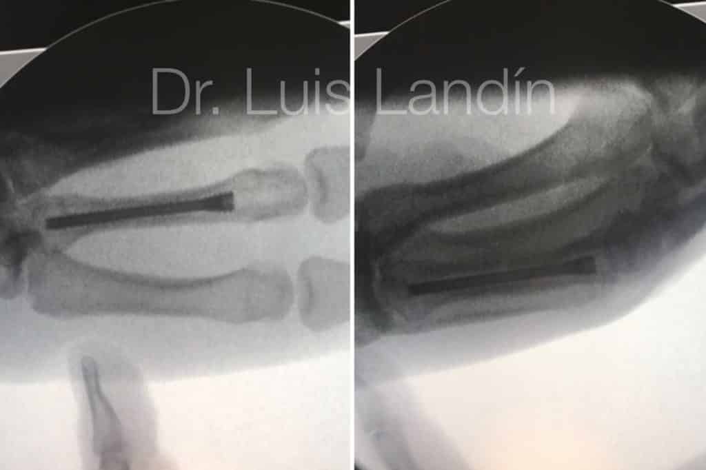 Fractura de metacarpiano tratada con tornillo canulado