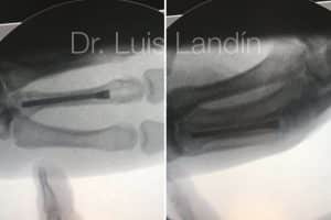 Fractura de metacarpiano tratada con tornillo canulado