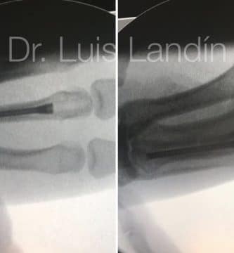 Fractura de metacarpiano tratada con tornillo canulado