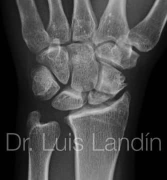 Fractura de polo proximal de escafoides