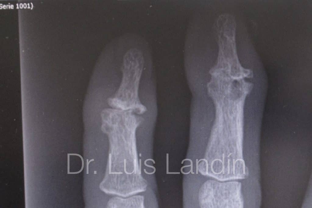 Artrosis severa de articulaciones de los dedos.