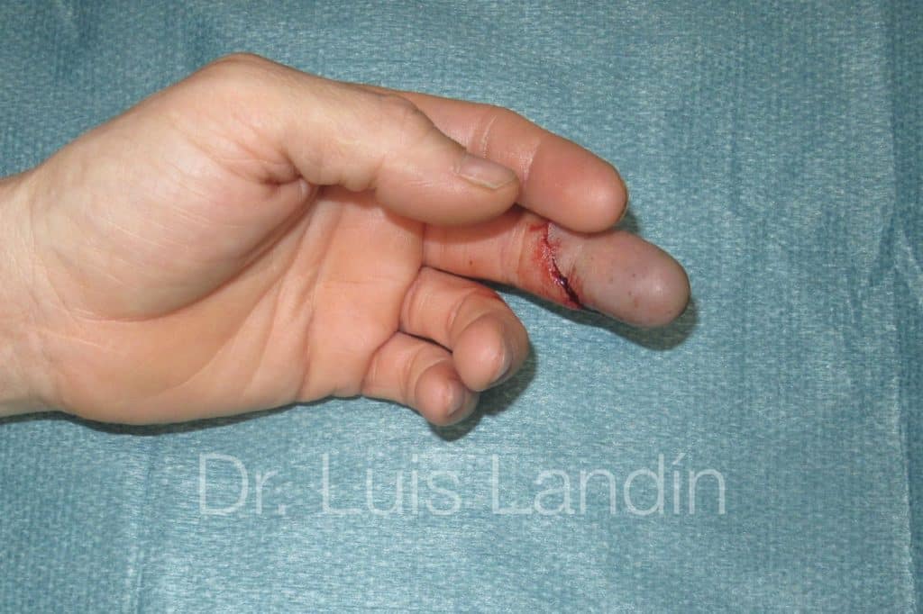 Lesión grave en 3er dedo con pérdida de circulación de la sangre.