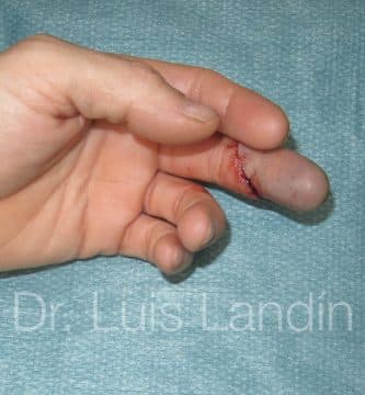 Lesión grave en 3er dedo con pérdida de circulación de la sangre.