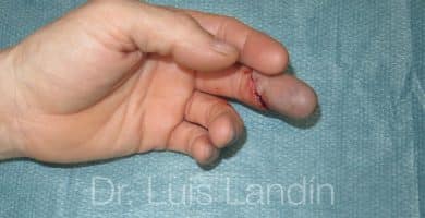 Lesión grave en 3er dedo con pérdida de circulación de la sangre.