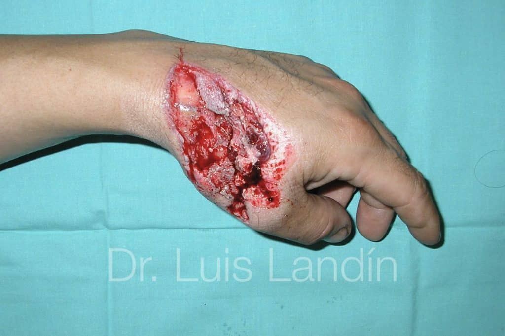 Lesión en dorso de mano.