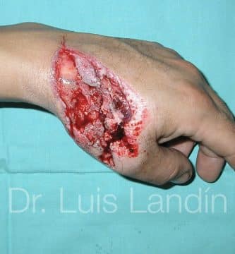 Lesión en dorso de mano.