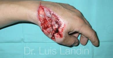 Lesión en dorso de mano.